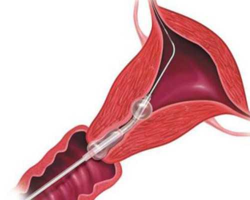 杭州辅助生殖与海外试管：潜山家庭赴美助孕费用及成功率深度解析